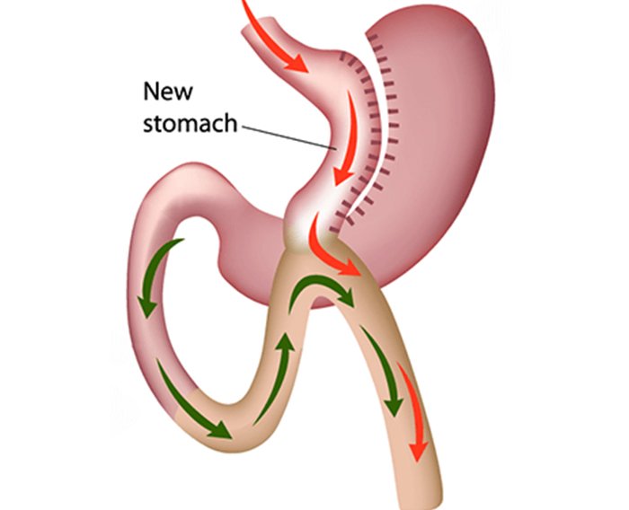 gastric bypass