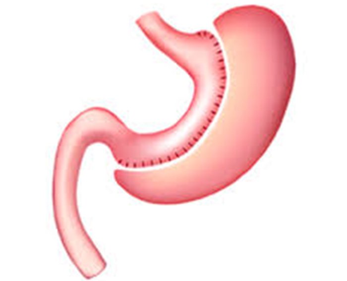 gastric sleeve