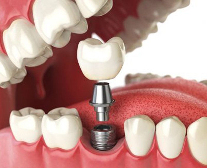 dental implant