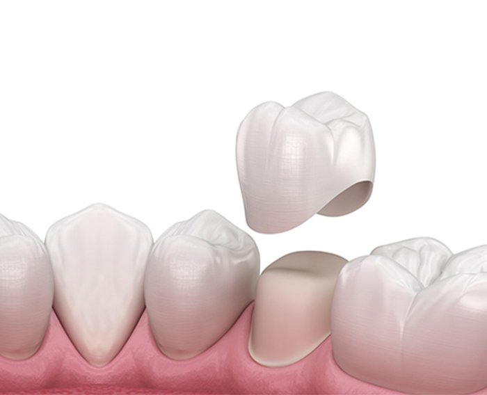 dental crowns