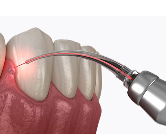 gum disease treatment