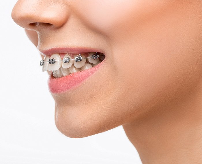 orthodontic treatment