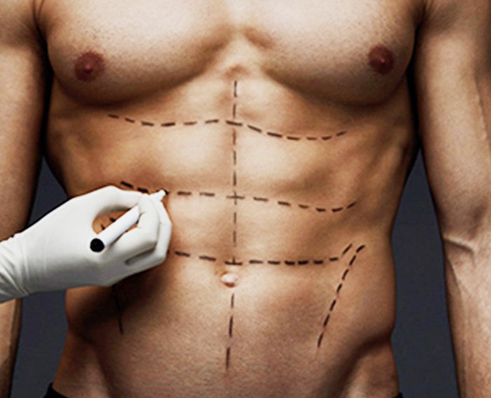 six pack surgery